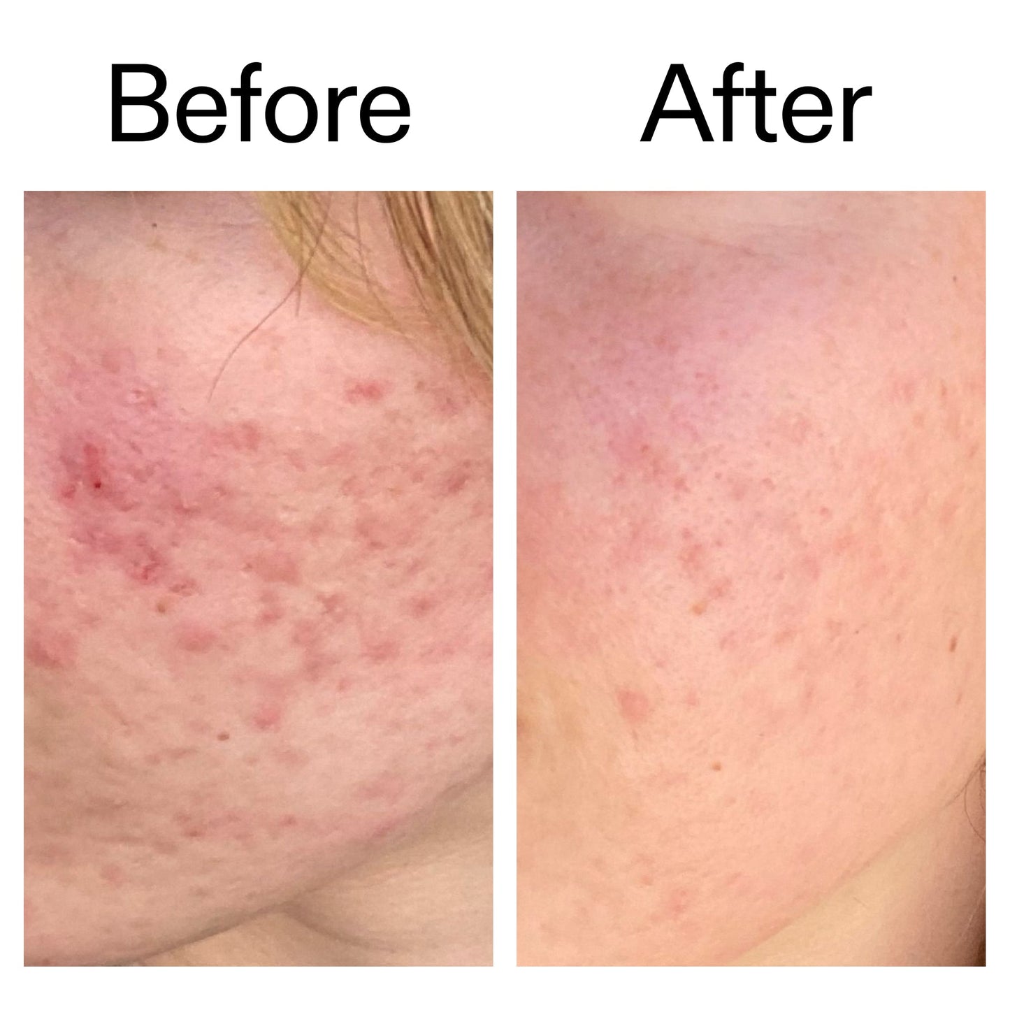 10-azelaic-acid-serum-for-redness-relief-o4 Azealic_Acid_Serum_B_A_Ppage_2000_x_2000.jpg