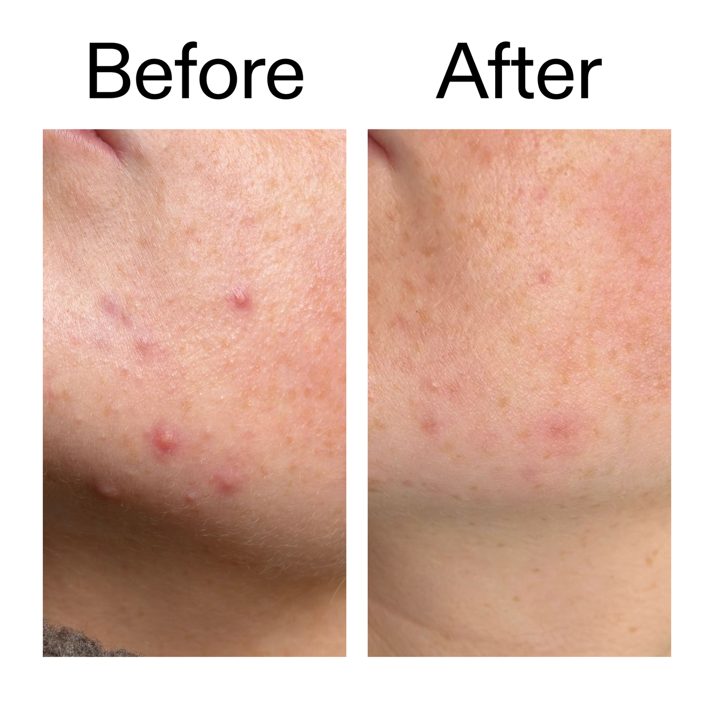 10-azelaic-acid-serum-for-redness-relief-o4 B_A_1_PPAGE.png