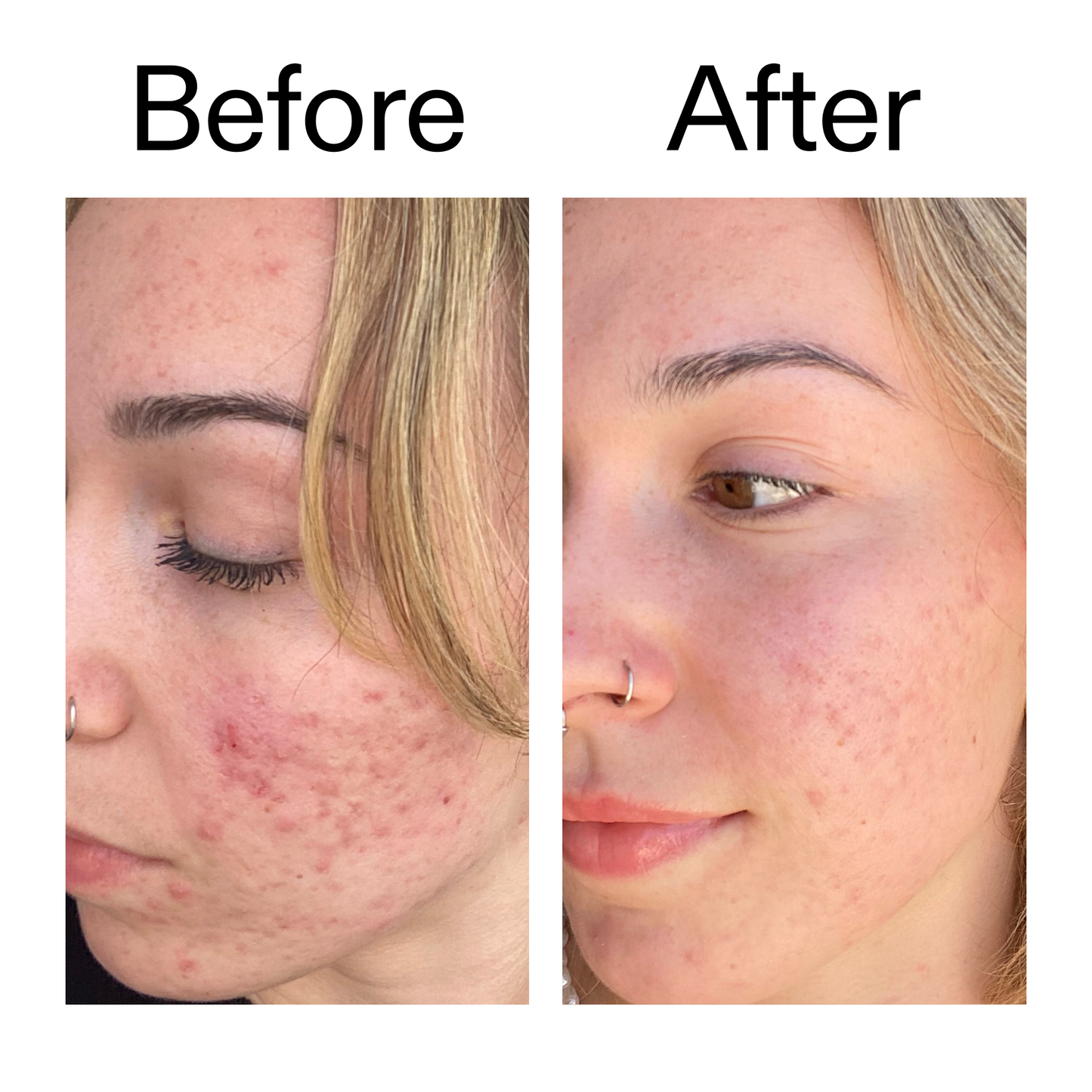 10-azelaic-acid-serum-for-redness-relief-o4 B_A_2_PPAGE.png