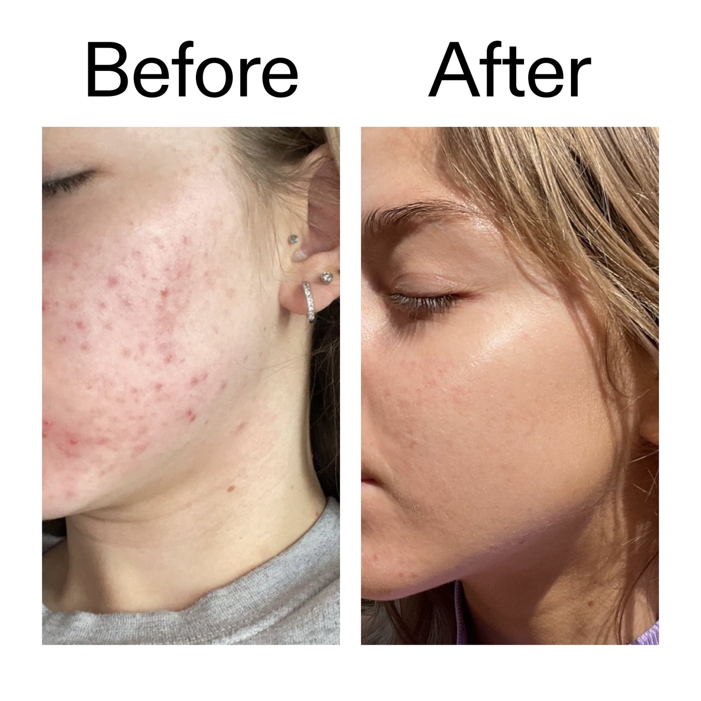 beta-hydroxy-acid-bha-serum-o7 Beta_Hydroxy_Acid_Serum_Before_After_2000x2000_96fda3e5-938d-49ef-bcf2-a0fa6ece4e2c.jpg