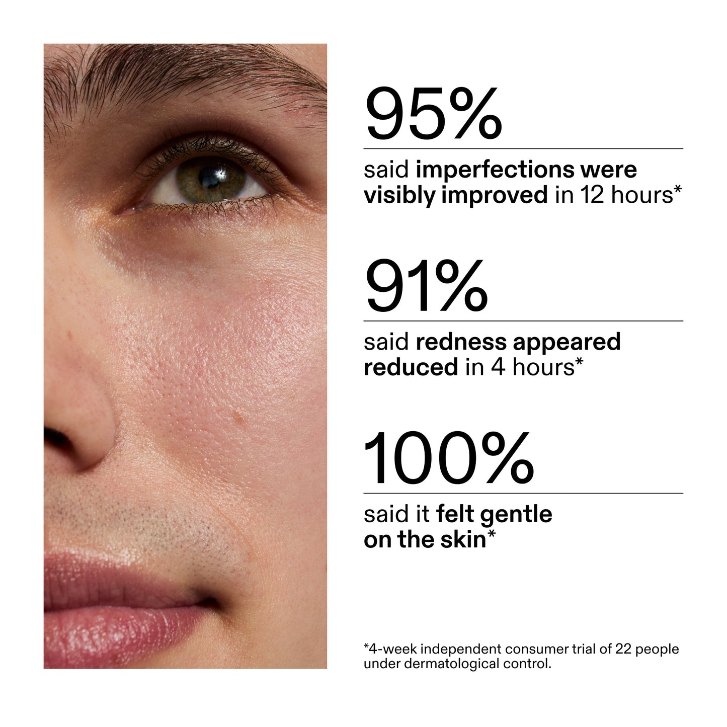 succinic-acid-acne-treatment-p6 CA_Succinic_Acid_Treatment_key_Claims_2000x2000_db91b0f1-7f29-4bfe-bb16-63a47f500960.jpg