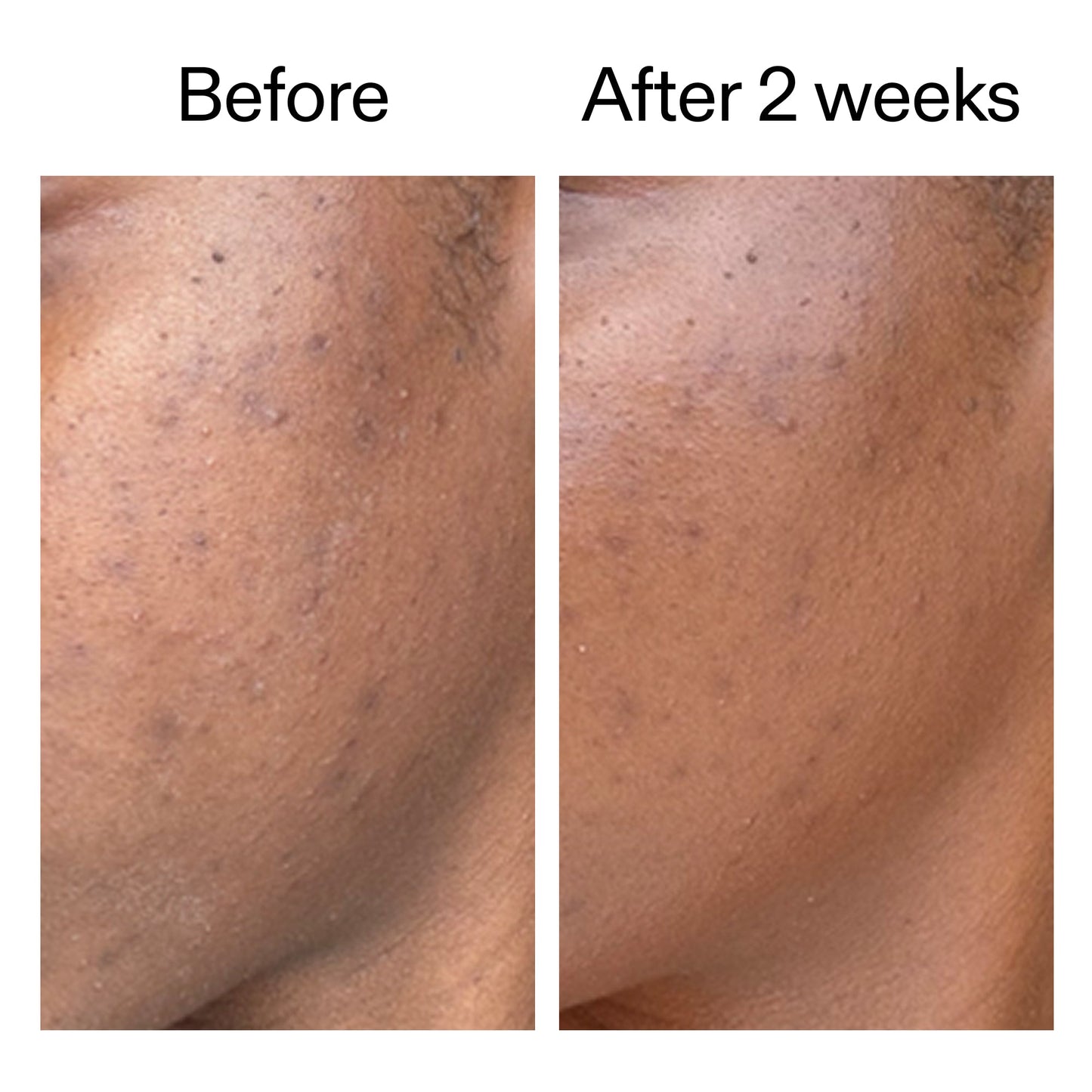 360-acne-clearing-serum-t8 DIOICB_A2000x2000.jpg