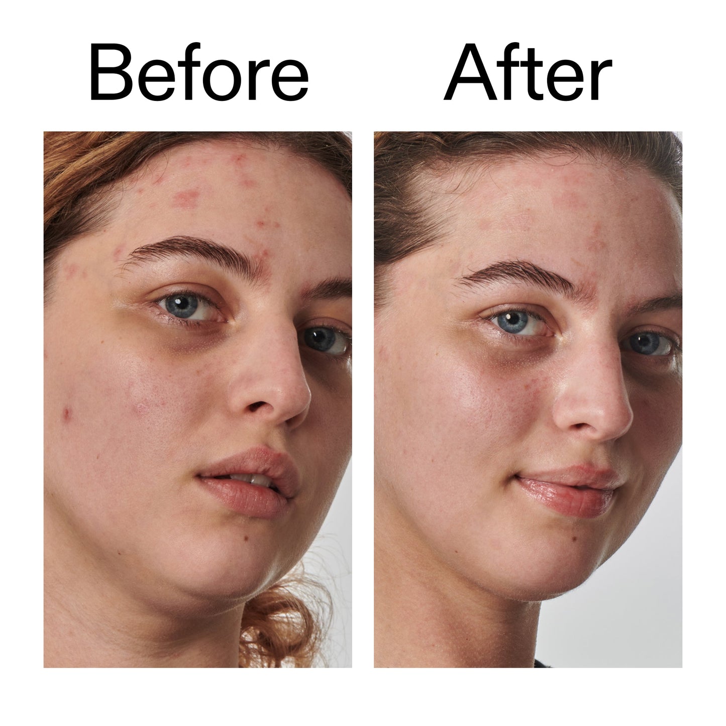 10-urea-moisturizer-d4 Dry_and_Rough_Skin_Solution_Before_After_2000x2000_efa6e639-5c39-49bd-a5dd-f0220293120a.jpg