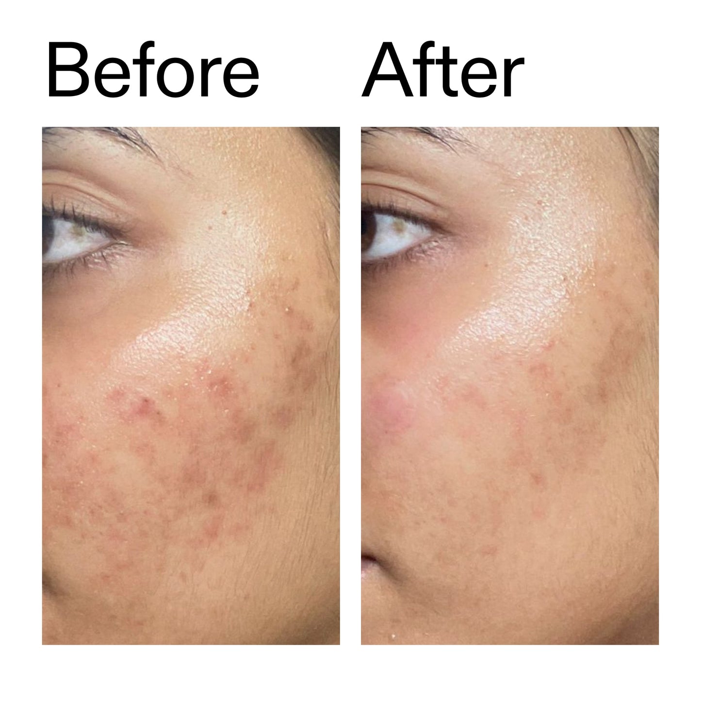 ectoin-hydro-barrier-serum-r0 Ectoin_Hydro-barrier_Serum__Before_After_2000x2000_34261920-d004-48d0-9c7b-8e1c15971bfd.jpg