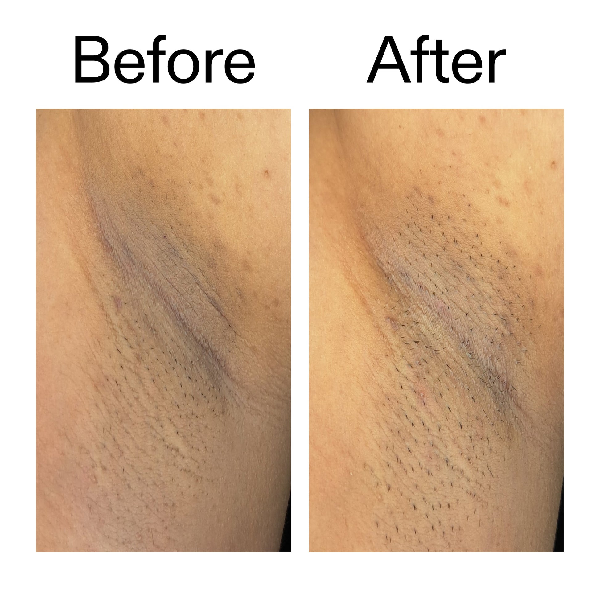 glycolic-acid-exfoliating-body-stick-duo-t8 Glycolic_Acid_Exfoliating_Body_Stick_Before_After_V3_2000x2000_ea919cd9-1439-4a46-82a0-76200eb5bb42.jpg
