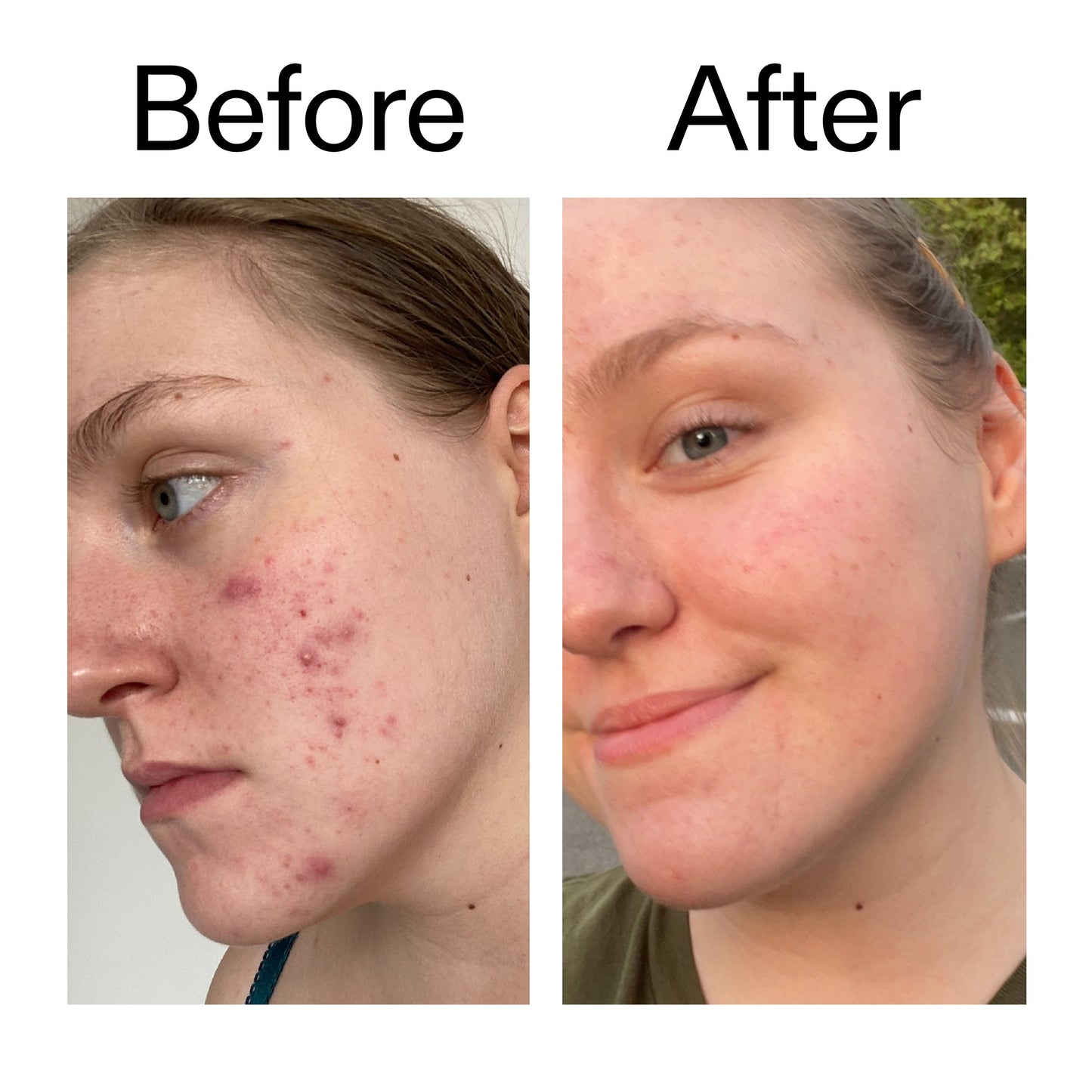 glycolic-acid-toner-v5 Glycolic_Acid_Toner_Before_After_2000x2000_49f0b9f7-e71b-4b2e-a8f8-2ea4b73247bb.jpg