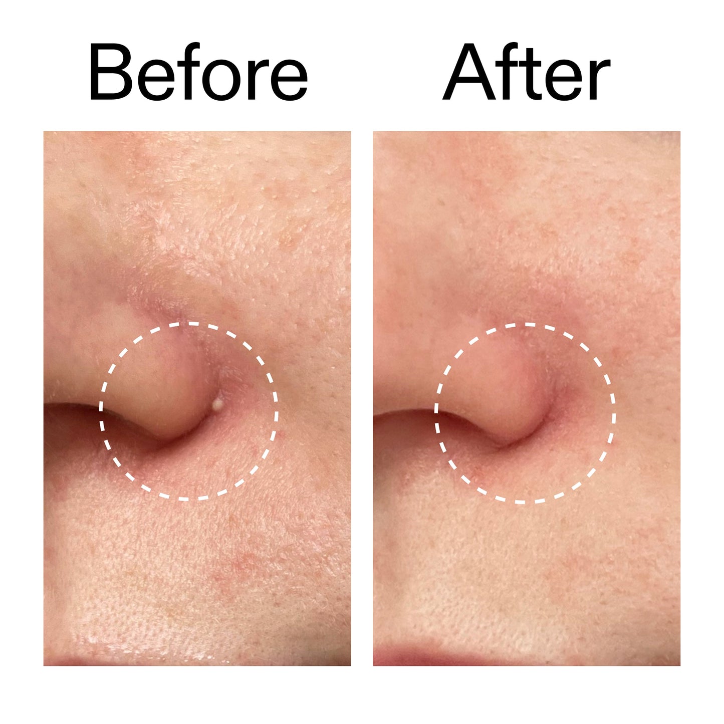 hydrocolloid-invisible-pimple-patches-pack-of-22-o3 Hydrocolloid_Invisible_Pimple_Patches_Before_After_2000x2000_b02aa37b-c78a-4682-91de-9135af5bb7df.jpg