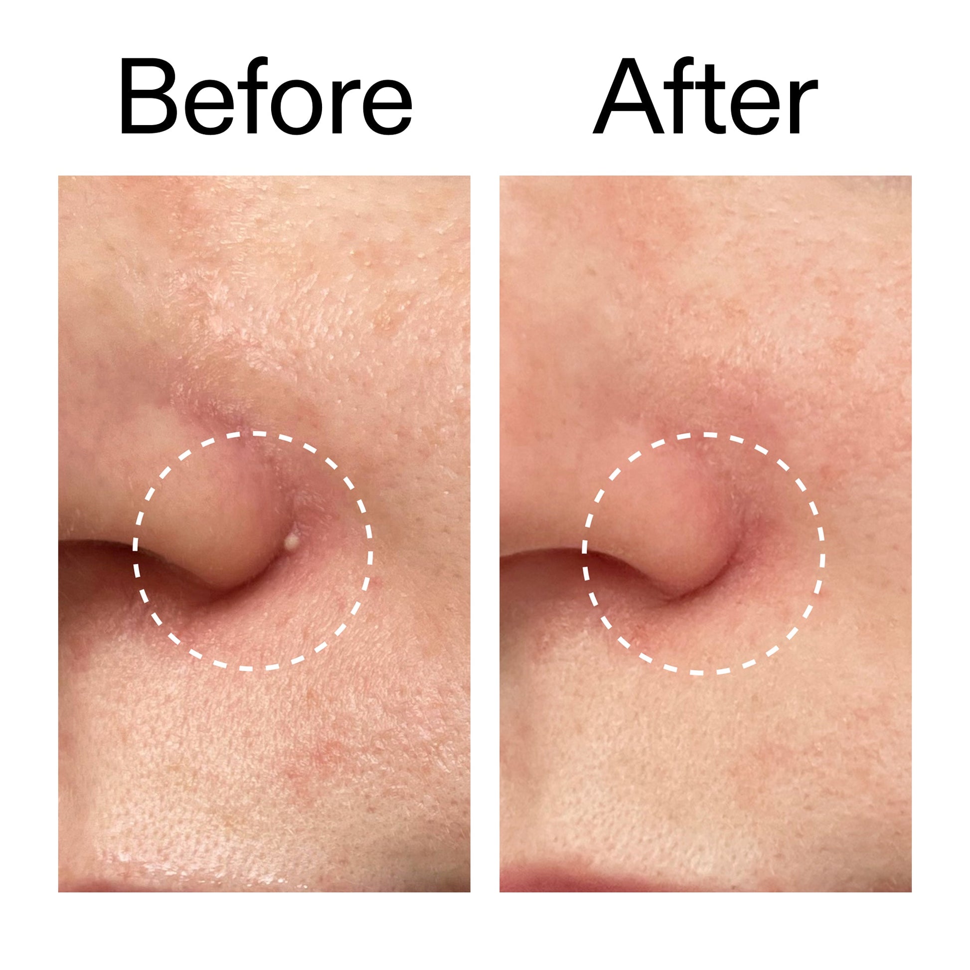 hydrocolloid-invisible-pimple-patches-pack-of-22-o3 Hydrocolloid_Invisible_Pimple_Patches_Before_After_2000x2000_b02aa37b-c78a-4682-91de-9135af5bb7df.jpg