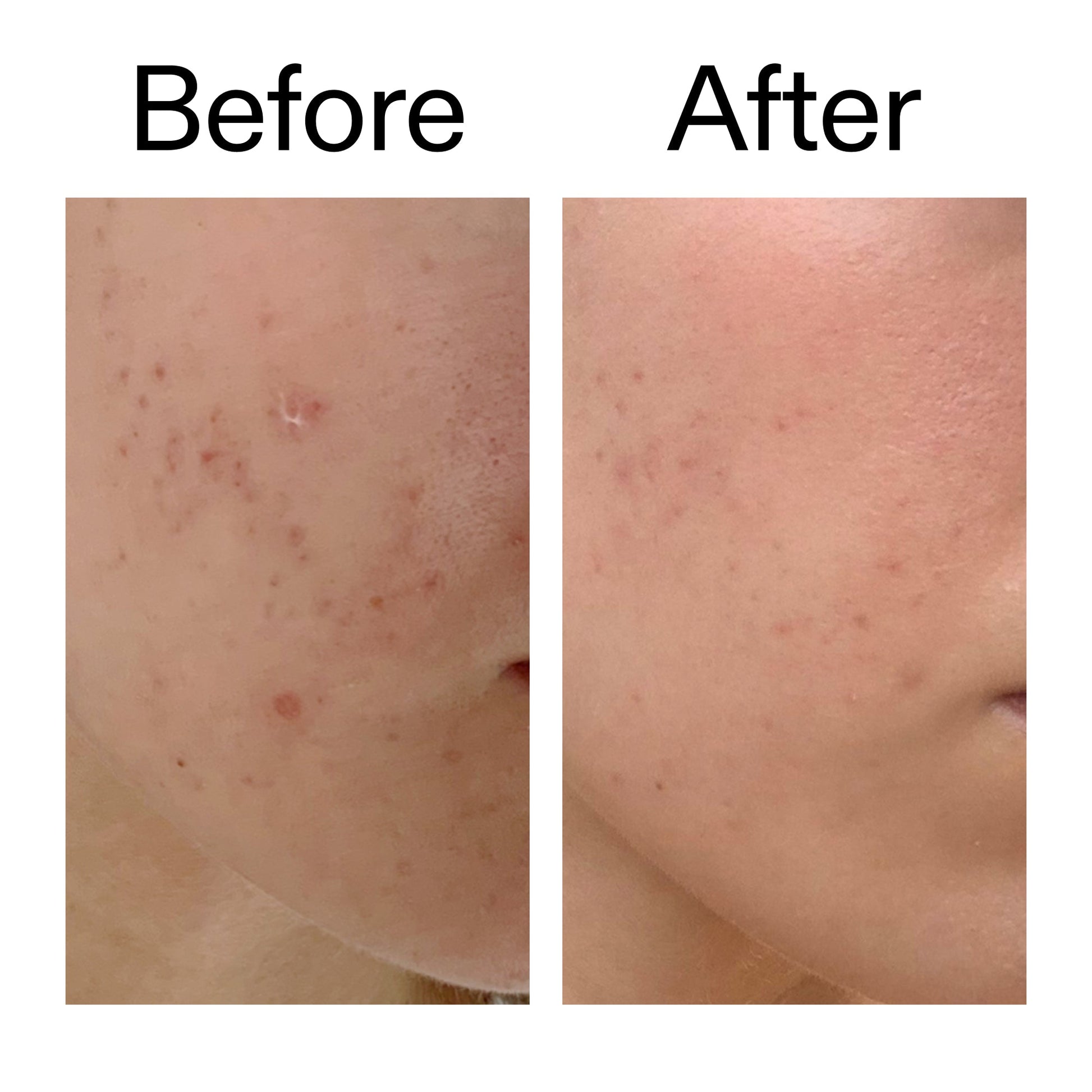mandelic-acid-treatment-d9 Mandelic_Acid_Treatment_Before_After_2000x2000_4885ac6e-c5d7-4279-a72a-1417af7dce35.jpg