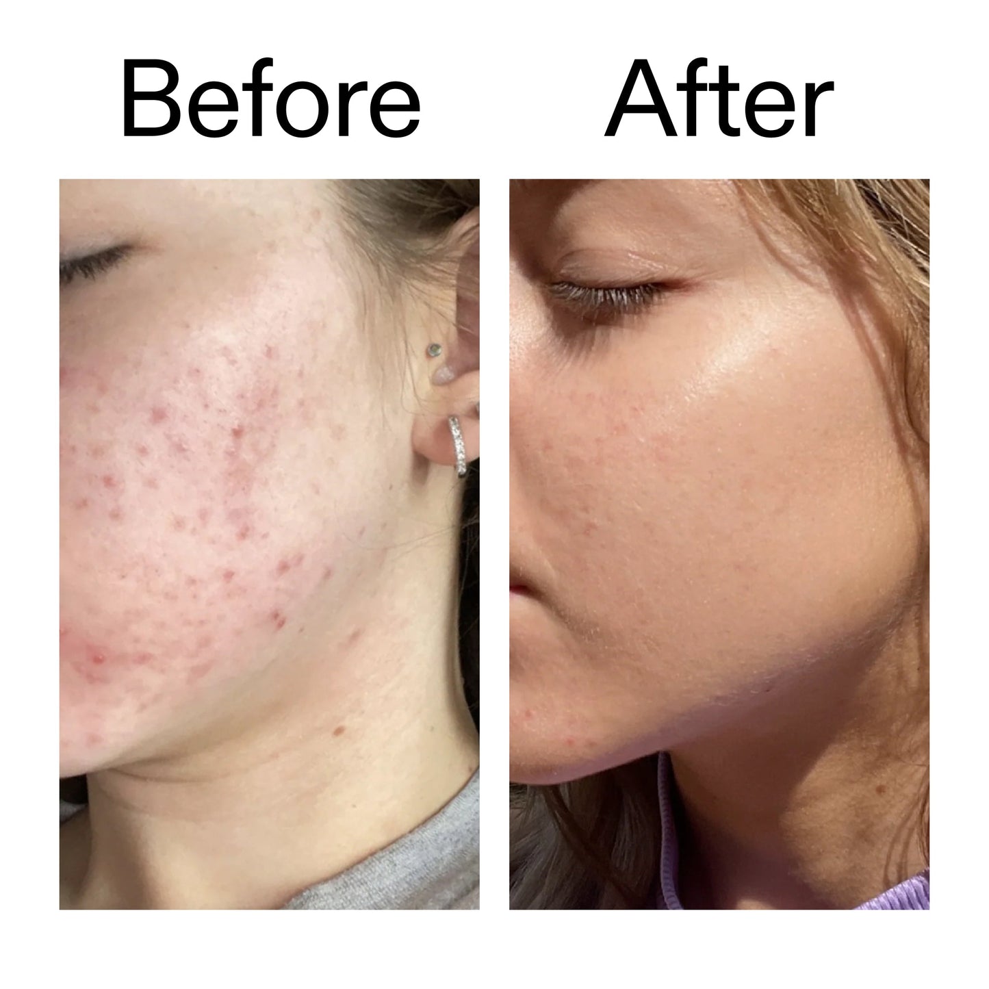 10-niacinamide-serum-duo-k3 Niacinamide_Serum_Before_After_2000x2000_bde32455-9e7d-448e-b053-bef41504f0a9.jpg