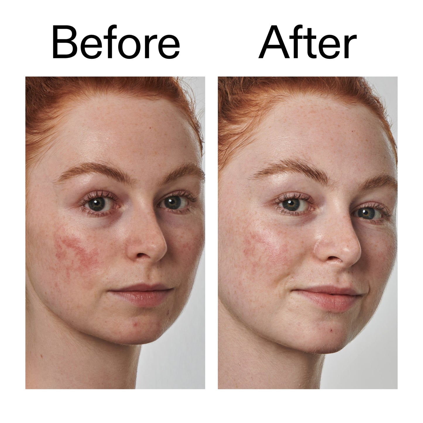 10-azelaic-acid-serum-for-redness-relief-o4 Redness_Relief_Serum_Before_After_2000x2000_3334dc9a-cce9-4e00-8aec-7ad89ca051f2.jpg