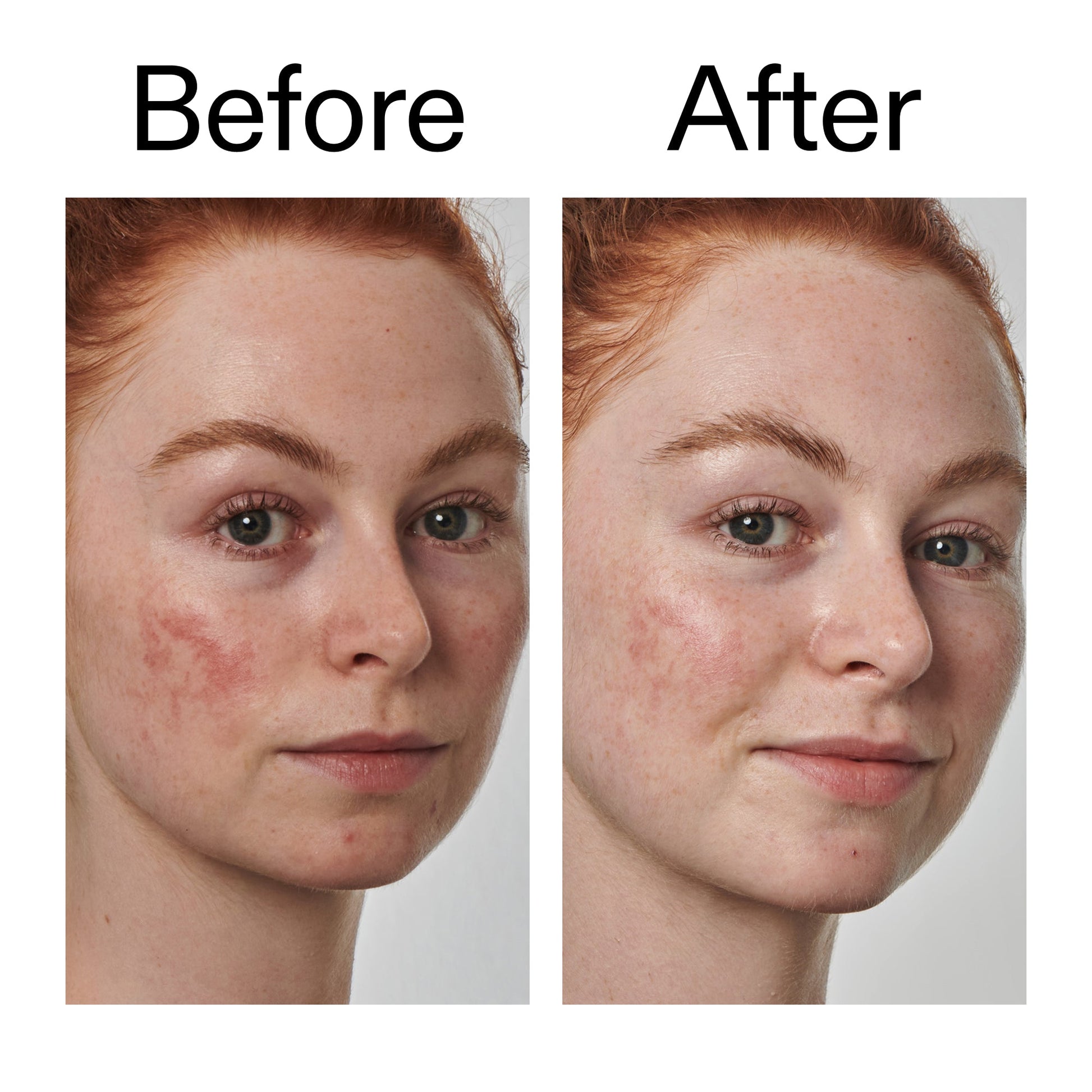 10-azelaic-acid-serum-for-redness-relief-o4 Redness_Relief_Serum_Before_After_2000x2000_3334dc9a-cce9-4e00-8aec-7ad89ca051f2.jpg