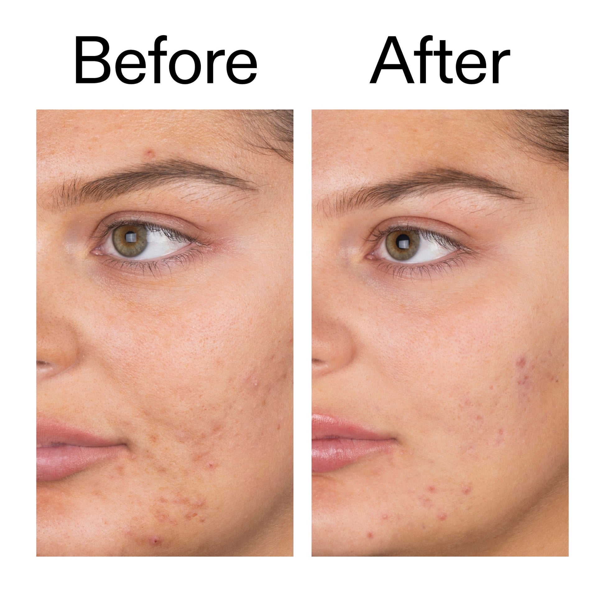 salicylic-acid-cleanser-150ml-f6 Salicylic_Acid_Cleanser_-_150ml_Before_After_2000x2000_e7230494-853f-4b07-82b1-27669104c995.jpg