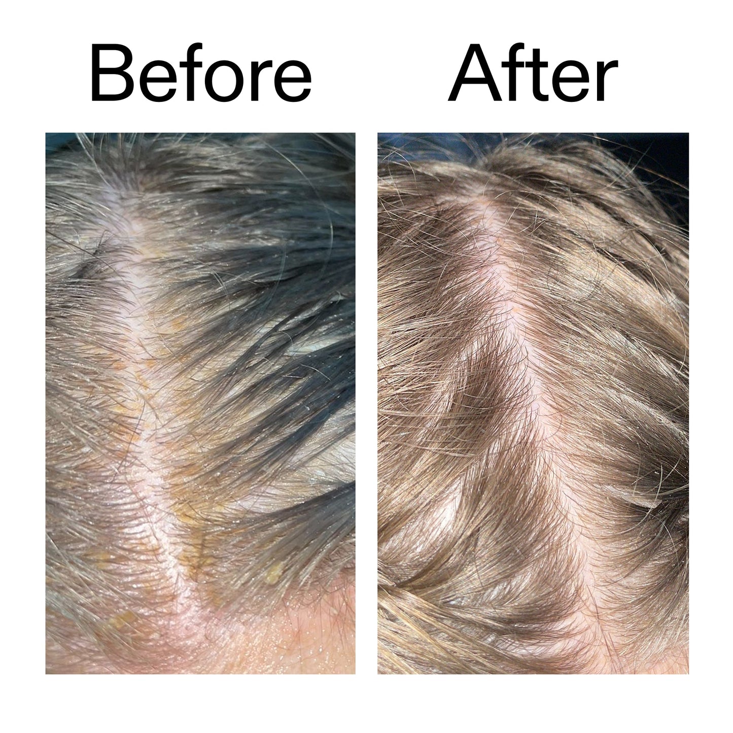 salicylic-acid-exfoliating-scalp-treatment-o7 Salicylic_Acid_Exfoliating_Scalp_Treatment_Before_After_2000x2000_e572a30f-057c-4a48-823b-1c09dc97f8d0.jpg