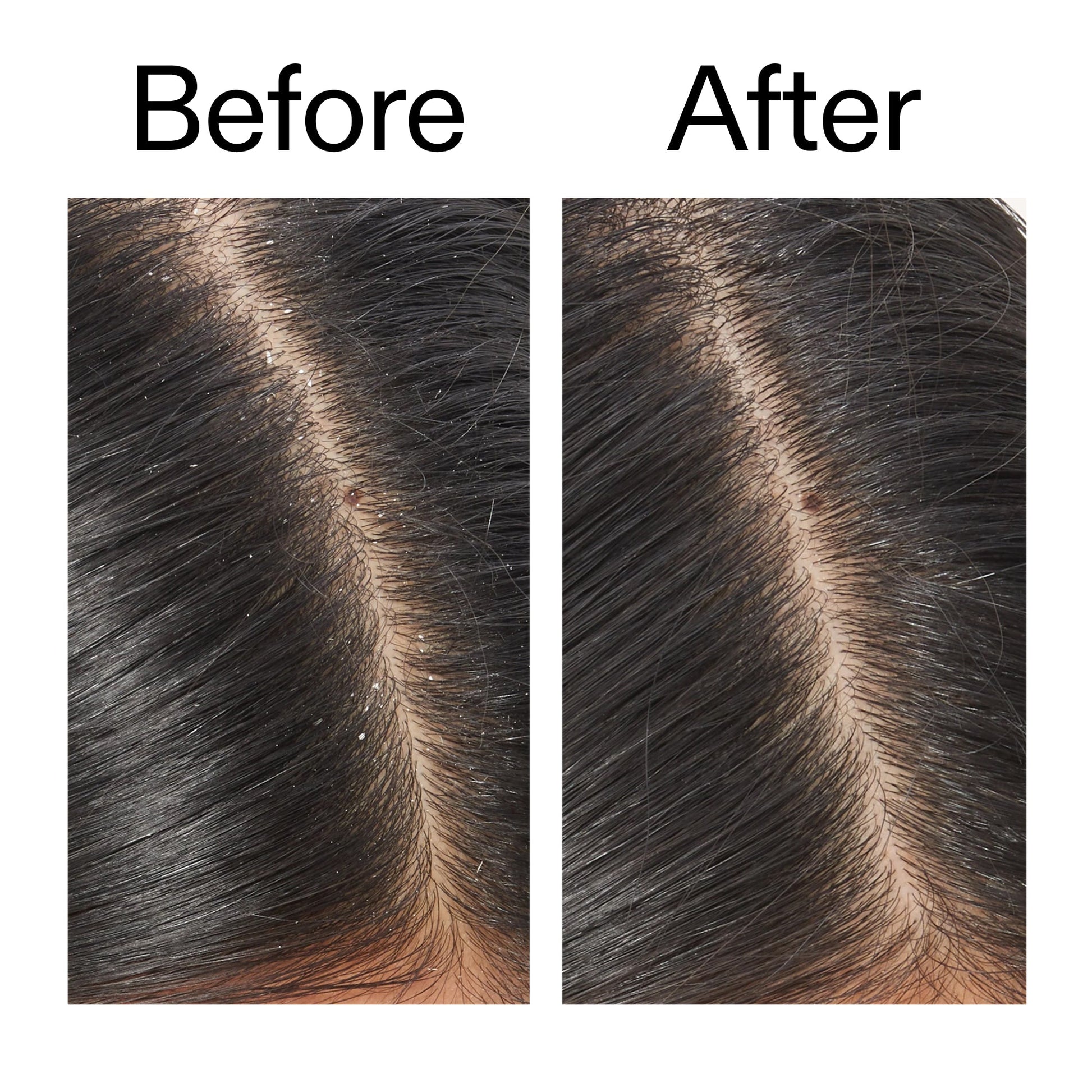 salicylic-acid-exfoliating-scalp-treatment-o7 Salicylic_Acid_Exfoliating_Scalp_Treatment_Before_After_V2_2000x2000_02bd61ad-42bf-490b-b3e3-7e04b2e8a673.jpg