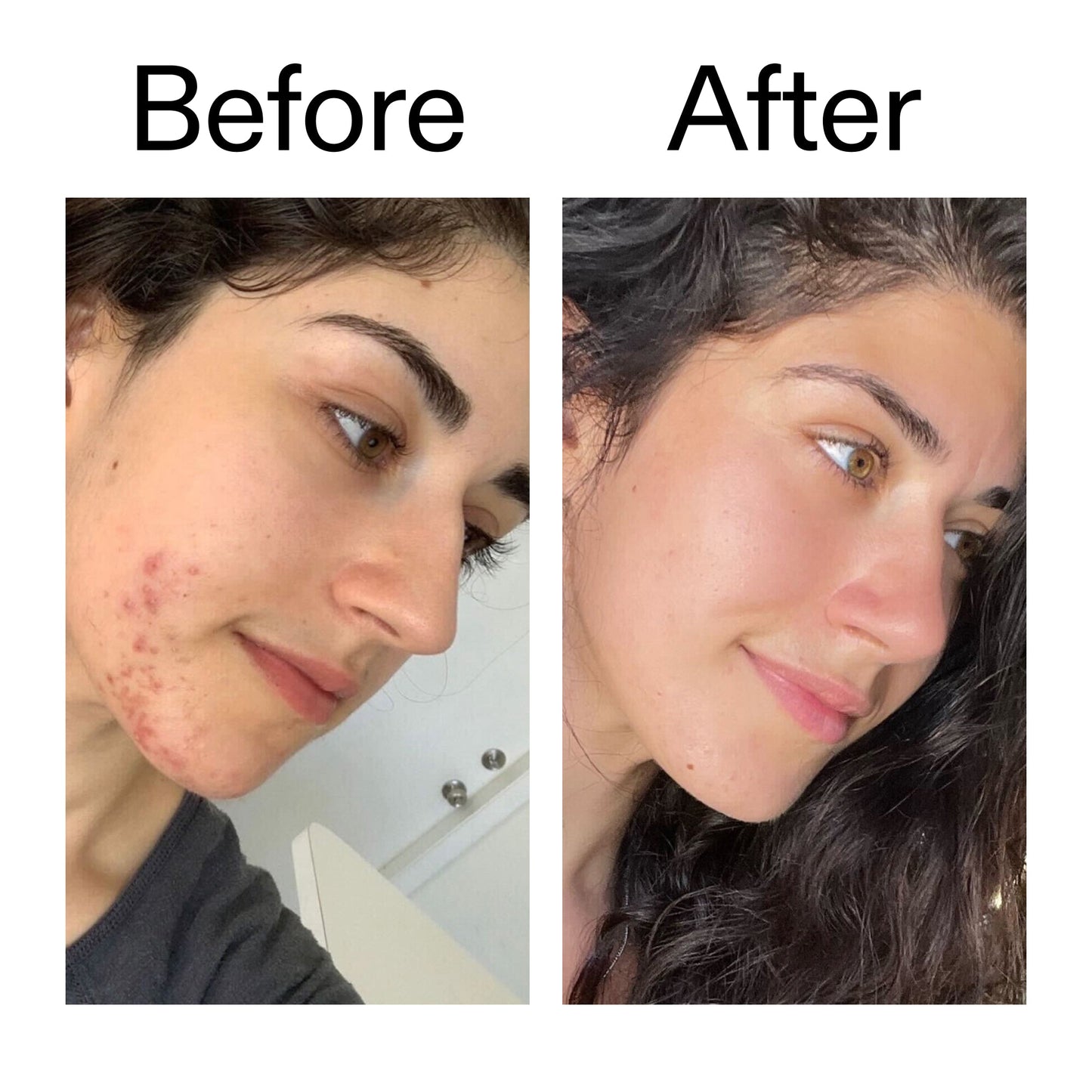 succinic-acid-acne-treatment-p6 Succinic_Acid_Treatment_Before_After_2000x2000_6a5f0054-2f58-4433-9314-0dc72c9bdd3b.jpg