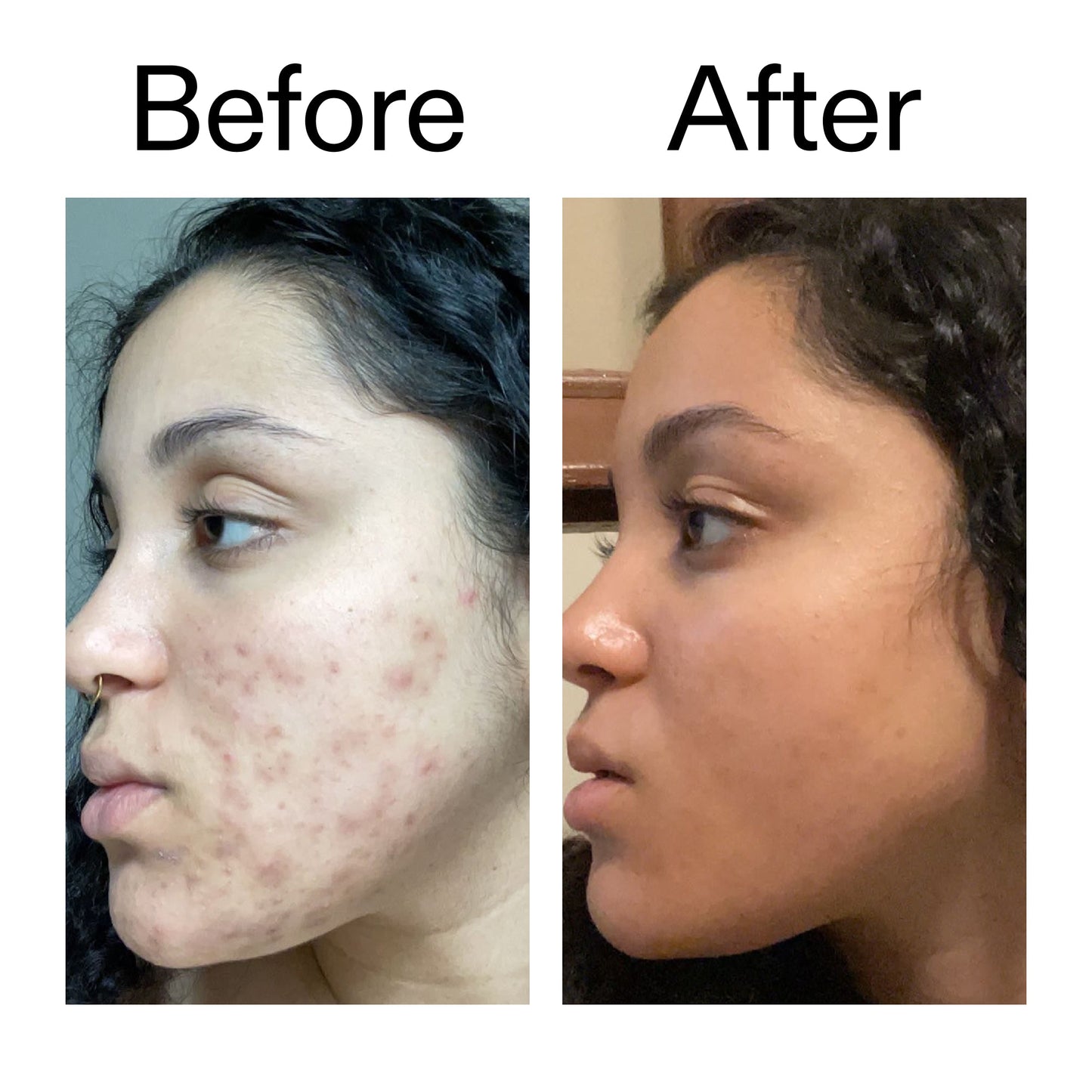 tranexamic-acid-serum-j0 Tranexamic_Acid_Serum_Before_After_2000x2000_98ebc8be-77b0-4843-8a22-90790ebe918b.jpg